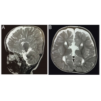 【佳学基因检测】唐奈-巴罗综合征基因检测（DBS)及其治疗
