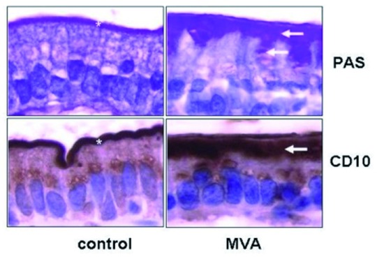 【佳学基因检测】戴维森病如何通过基因检测确诊Davidson disease?