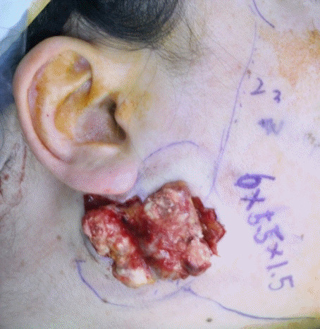 【佳学基因检测】巨大毛母质瘤的基因检测案例 【佳学基因检测】巨大毛母质瘤的基因检测案例