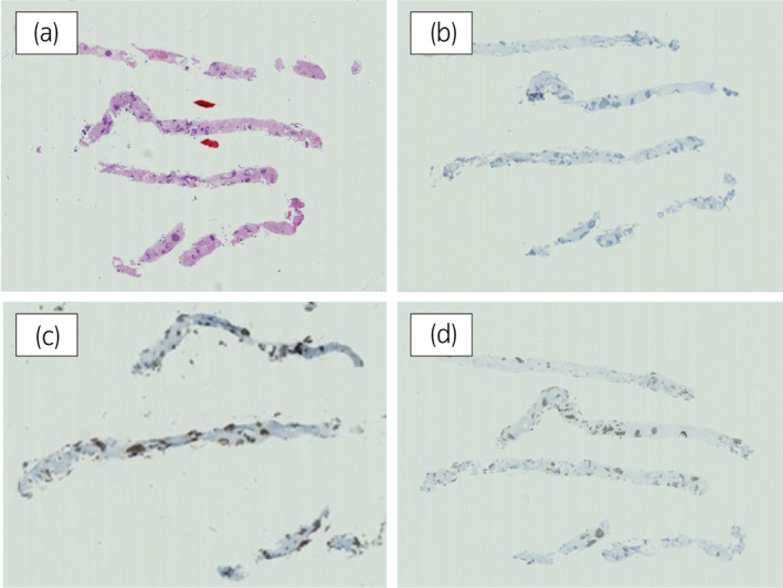 【佳学基因检测】靶向药物奥拉帕尼治疗具有BRCA突变的前列腺癌患者 【佳学基因检测】靶向药物奥拉帕尼治疗具有BRCA突变的前列腺癌患者