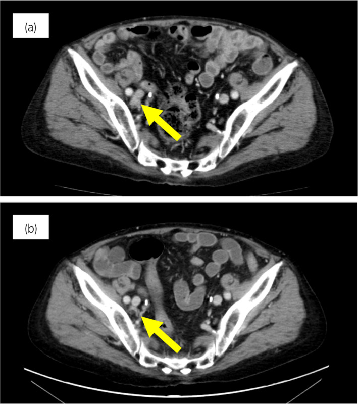 【佳学基因检测】靶向药物奥拉帕尼治疗具有BRCA突变的前列腺癌患者 【佳学基因检测】靶向药物奥拉帕尼治疗具有BRCA突变的前列腺癌患者