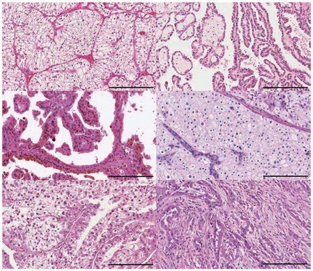 【佳学基因检测】肾细胞癌的分子诊断及分类 【佳学基因检测】肾细胞癌的分子诊断及分类