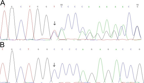 【佳学基因检测】睑裂狭小综合征1型基因解码、基因检测的报告有人解读吗? 【佳学基因检测】睑裂狭小综合征1型基因解码、基因检测的报告有人解读吗?