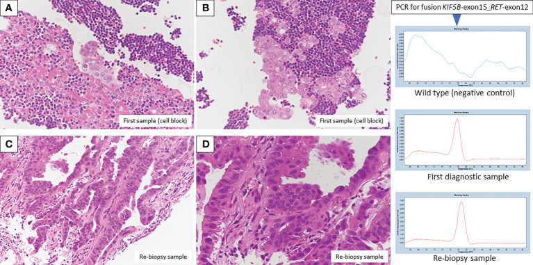 【佳学基因检测】肺癌靶向药物基因检测为什么要包含RET重排
