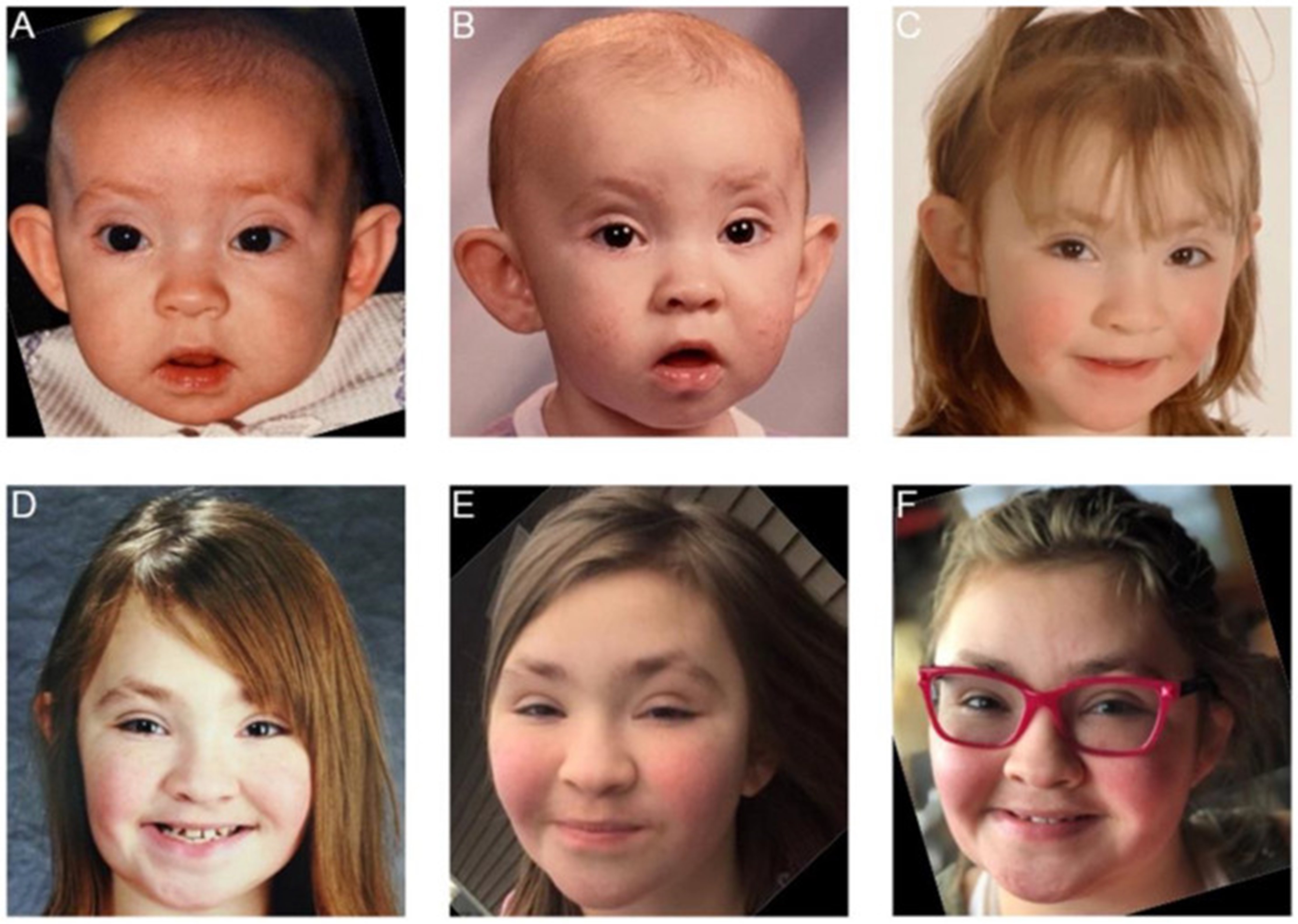 【佳学基因检测】歌舞伎化妆综合征基因检测Kabuki make-up syndrome 【佳学基因检测】歌舞伎化妆综合征基因检测Kabuki make-up syndrome