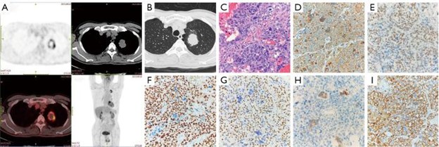 【佳学基因检测】男性原发性肺绒毛膜癌基因检测报告 【佳学基因检测】男性原发性肺绒毛膜癌基因检测报告