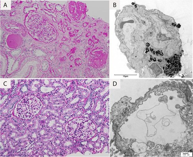 【佳学基因检测】遗传性肾脏疾病基因解码与基因检测:COL4A4突变及解释 【佳学基因检测】遗传性肾脏疾病基因解码与基因检测:COL4A4突变及解释