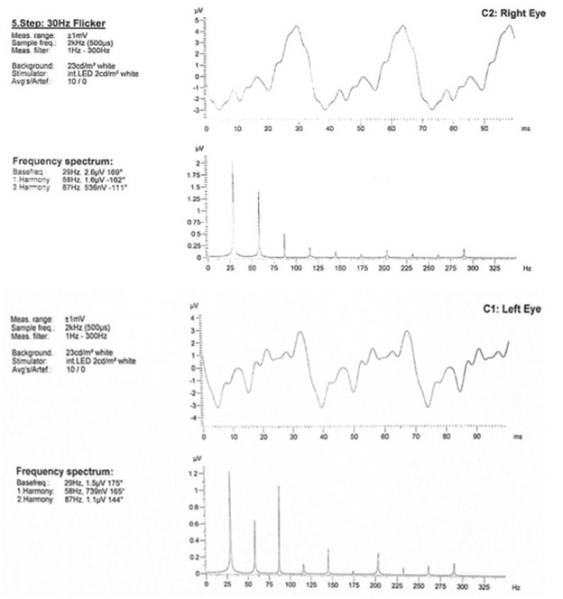 【佳学基因检测】巨额花费肾移植，却得了视网膜纤毛病：基因检测在肾病与眼科共病中的作用