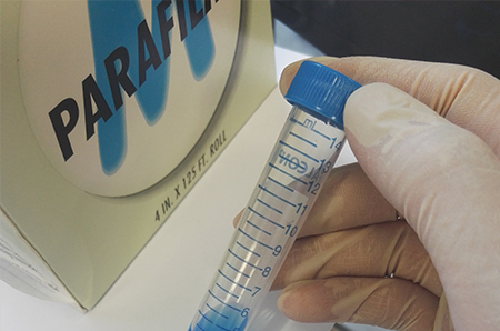 【佳学基因解码-基因检测】小心这种指甲半月牙异常,有可能是指甲髌骨综合征 【佳学基因解码-基因检测】小心这种指甲半月牙异常,有可能是指甲髌骨综合征