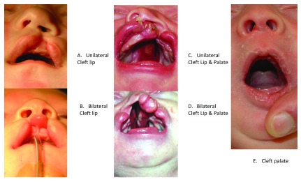【佳学基因检测】唇裂、腭裂、唇腭裂遗传吗？如何阻断？