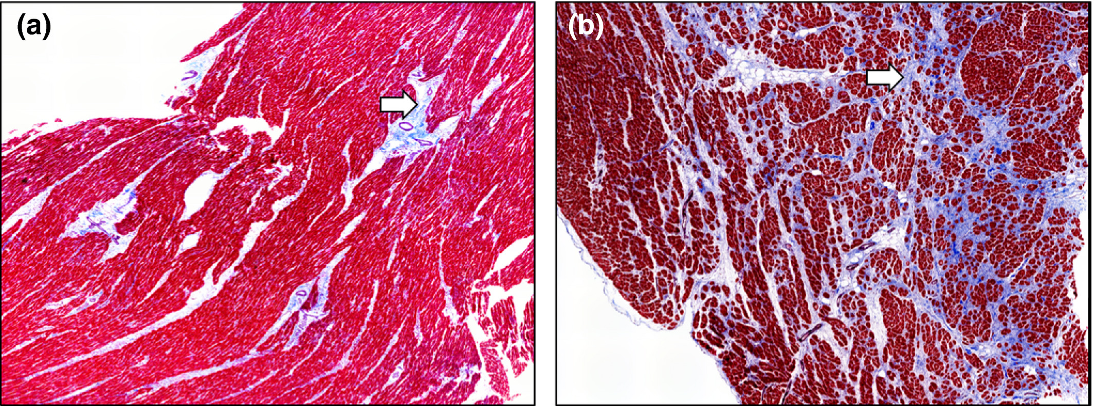 【佳学基因检测】理解发病机理,选择准确的扩张性心肌病基因检测 【佳学基因检测】理解发病机理,选择准确的扩张性心肌病基因检测