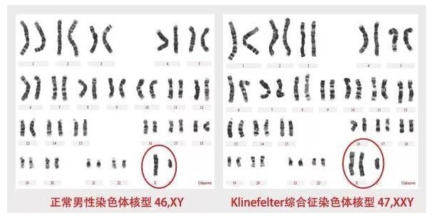 【佳学基因检测】最新:针对克氏综合征患者显微取精成功率的预测分析 【佳学基因检测】最新:针对克氏综合征患者显微取精成功率的预测分析