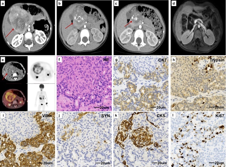 【佳学基因检测】胰腺母细胞瘤基因检测